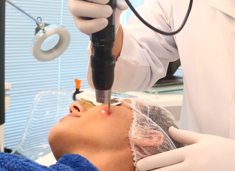 Procedimento a laser ajuda a combater o melasma